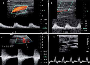 a.- Curva de baja resistencia en Arteria femoral común b.- Curva tardus pardus en peronea del mismo paciente c.- Estos hallazgos nos obligan a buscar una estenosis a nivel proximal, constatándose una estenosis iliaca d.- Curva trifásica, de alta resistencia, normal para AFC y arteria peronea del lado contralateral.