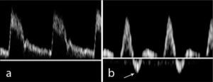 a.- Curva de baja resistencia, con flujo anterógrado en sístole y diástole b.- Flujo de alta resistencia con flujo reverso diastólico precoz (flecha).