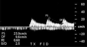 Medición del índice de resistencia (IR), basado en el peak sistólico (PS) y la diastólica final (DF).