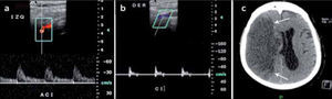 a.- Curva normal de baja resistencia en carótida interna (CI) izquierda b.- Curva de alta resistencia, patológica, en CI derecha c.- TAC muestra extenso infarto hemisférico derecho (flechas) por oclusión de CI distal al sitio del examen ecográfico.