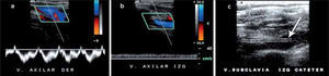 a.- Curva a nivel de vena axilar derecha, con adecuada variabilidad b.- Curva a nivel de vena axilar izquierda, con pérdida de variabilidad lo que nos hace sospechar oclusión proximal c.- Trombosis aguda completa de la vena subclavia, responsable del aplanamiento de la curva axilar. Presencia de catéter endovascular (flecha).