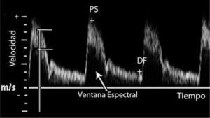 Curva espectral que registra velocidad de los glóbulos rojos a través del tiempo. PS: peak sistólico; DF: diastólica final. Líneas horizontales muestran velocidades máxima y mínima, en un tiempo determinado (línea vertical). Valores positivos (+) se acercan al transductor y negativos (-) se alejan.