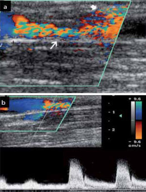 a.- Estenosis arterial. El aumento de velocidad se presenta como un mosaico de color (flecha fina). Artefacto perivascular (flecha gruesa) b.- Aumento de velocidad. La curva espectral muestra velocidad normal en el segmento anterior y aumento significativo de ésta en la estenosis.