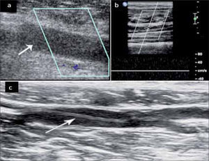 Trombosis Venosa a.- Vaso aumentado de calibre, ocupado por trombo hipoecogénico (flecha), no compresible, sin señal color b.- Trombosis, sin señal espectral c.- Trombo antiguo, retraído (flecha).