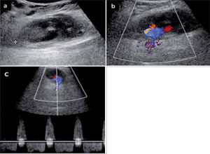 Pseudoaneurisma parcialmente trombosado a.- Modo B muestra lesión ovoidea, hipoecogénea, heterogénea en región inguinal b- El modo doppler color muestra flujo en parte de la lesión c- El modo espectral muestra típica curva de un pseudoaneurisma (to and fro).