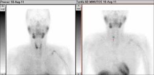 Imágenes precoz y tardía con 99mTc-MIBI demuestra retención aumentada confirmando un adenoma paratiroideo inferior derecho.