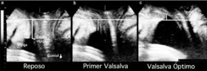Traducido de: Efecto de la co-activación del músculo elevador del ano en el descenso del cuello vesical. Vista medio sagital en reposo (a), primera maniobra de valsalva enmascarada por la co-activación del músculo elevador (b) y valsalva óptima luego del biofeedback con la paciente (c). Las líneas horizontales indican el margen inferior de la sínfisis del pubis. Las líneas verticales indican el cuello vesical. Es evidente que el cuello vesical desciende más al optimizar la maniobra de valsalva. LA, elevador del ano. Con autorización de Dietz et al. (11).