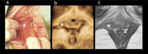 Avulsión del lado derecho del músculo puborrectal luego de un parto vaginal de término. La imagen de la izquierda (a) muestra la apariencia inmediatamente post parto, con la avulsión del músculo expuesta por un gran desgarro vaginal. El músculo desgarrado se retrae y esto es visible entre los dedos del operador a las 6 y 7h de los punteros del reloj. La imagen del medio (b) muestra el volumen renderizado (plano axial del ultrasonido 3D del piso pélvico) 3 meses post parto, y la imagen de la derecha (c) muestra los hallazgos en la Resonancia nuclear magnética a los 3,5 meses post parto. Con autorización de: Dietz H. Et al.(17).
