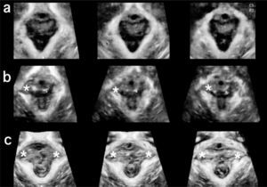Ultrasonido tomográfico del haz puborrectal del elevador del ano. La imagen superior (a) muestra la visualización normal del músculo, la imagen del medio (b) muestra una avulsión unilateral derecha y la imagen inferior (c) presenta una avulsión bilateral).