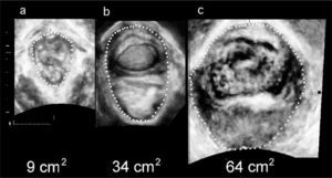 Ultrasonido 3D transperineal en el plano axial que muestran el área del hiato del elevador durante la maniobra de valsalva, representada por la linea punteada. La imágenes de izquierda a derecha muestran un hiato normal con área de 9 cm2 (a), balonamiento moderado de 34,4 cm2 (b) y severo de 64 cm2 (c) en pacientes con prolapso sintomático).