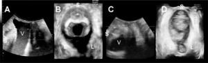 Reducción del hiato de 35 a 22 cm2 3 meses luego de la inserción del sling puborrectal. Plano medio sagital (A) y axial (B) durante valsalva antes de la cirugía y plano medio sagital (C) y axial (D) 3 meses luego del procedimiento. 5 sínfisis del pubis, V vejiga, L elevador del ano.)