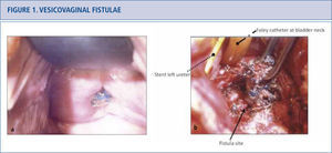 Vesicovaginal fistulae a) Patient presented with anterior vaginal midline mesh erosion and an associated vesicovaginal fistula. Site of mesh erosion was located near the left ureteric orifice by cystoscopy. b) Surgical options for vesicovaginal fistula involving an exposed mesh include transabdominal or transvaginal repairs. Transabdominal repair of the vesicovaginal fistula with removal of mesh was performed. The left ureteric orfice was in very close proximity to the fistula and is depicted by the arrow, but was not reimplanted.