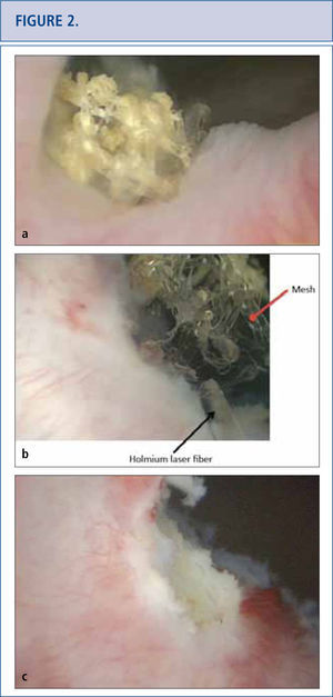 a) Cystoscopic view of mesh extended at the right side of the bladder neck, covered with calcifications 5 years after placement of a retropubic midurethral sling. b) Holmium laser (365 micron fiber) was used to eliminate as many mesh fragments as possible. c) Cystoscopic view of completed laser resection of the bladder neck mesh revealing no residual tape.