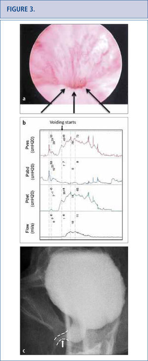 Persistent lower urinary tract symptoms (frequency, urgency and mixed urinary incontinence), recurrent UTIS and incomplete emptying in a 50 year old woman who underwent a “loosening of her tape” at 3 months post-op. Cystoscopy revealed no exposed tape to explain her UTIs, but a very narrow lumen with elevation and flattening of urethral floor depicted by the arrow in Figure 3a. Urodynamics (3b) and voiding cystogram confirmed obstruction and its site (arrow on 3c). Tape loosening or incision does not always release an obstruction completely and persistent symptomatology should raise the concern for residual obstruction.