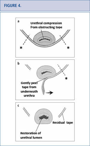 (Images modified from Dillon B, Gurbuz C, Zimmern P. Long term results after complication of “prophylactic” suburethral tape placement. Can J Urol. 2012; 19:6424-30.) a) MUS placed underneath the urethra should be tension free but can result in urethral kinking and distortion. It is preferable to incise the tape on the side of the urethra (marked by *) to reduce risk of urethral injury. b) Tape is carefully peeled away from underneath the urethra. c) After midurethral tape excision, urethroscopy helps confirm no urethral injury and documents restoration of a normal urethral lumen.