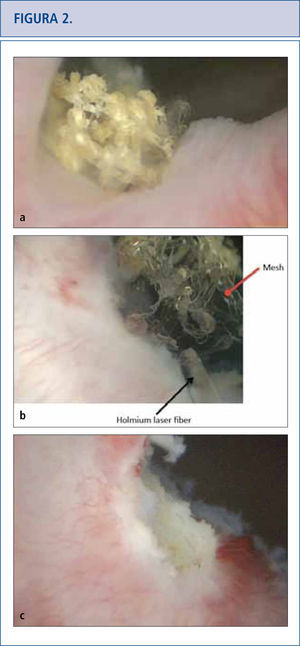 a) Vista cistoscópica de la malla extendida al lado derecho del cuello de la vejiga, cubierta por calcificaciones 5 años después de la colocación de una cinta en la uretra media retropúbica. b) Se utilizó láser de holmio (fibra de 365 micrones) para eliminar la mayor cantidad de fragmentos de malla posibles. c) Vista cistoscópica de una resección de láser completa del cuello de la vejiga que no muestra ningún residuo de cinta.