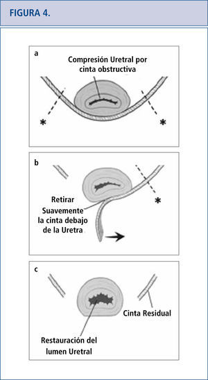 (mágenes modificadas procedentes de Dillon B, Gurbuz C, Zimmern P. Long term results after complication of “prophylactic” suburethral tape placement. Can J Urol. 2012; 19: 6424-30.). a) El MUS colocado bajo la uretra debiera estar sin tensión pero esto puede terminar en el retorcimiento y distorsión de la uretra. Es preferible hacer una incisión en la cinta en el lado de la uretra (marcado por *) para reducir el riesgo de daño uretral. b) La cinta es cuidadosamente extraída de debajo de la uretra. c) Luego de la excisión de la cinta de la uretra media, la uretroscopía ayuda a confirmar la ausencia de daño uretral y la restauración de documentos de un lumen uretral normal.