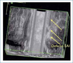 Defecto esfínter anal interno (EAI)
