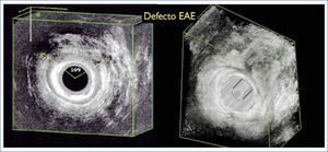 Defecto esfínter anal externo (EAE)