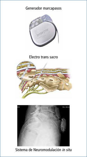 Neuromodulación sacra
