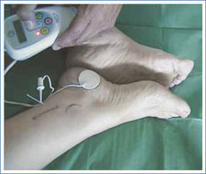 Neuromodulación tibial posterior