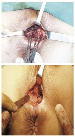 Esfinteroplastia