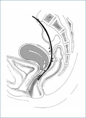 Esquema Rectopexia Ventral (tomado de D´Hoore et al, referencia 31)