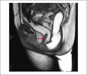 Enterocele. Secuencia TrueFisp sagital en línea media durante maniobra de defecación. Signos de histerectomía. Hay herniación de grasa omenta anterior al recto (flecha), asociado a rectocele anterior y cistocele.