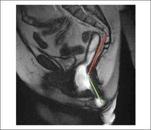Ángulo ano-rectal (AAR) durante la maniobra de defecación. Secuencia TrueFisp sagital en línea media. La línea verde representa el eje del canal anal y la línea naranja la pared posterior del recto bajo. El AAR es de aproximadamente 135 grados