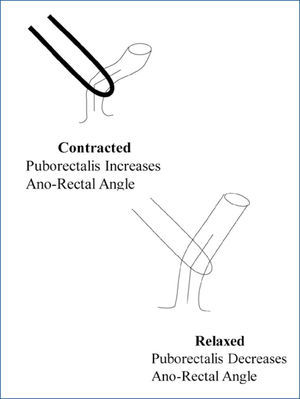 The role of the pelvic floor in the maintenance of continence and the facilitation of defecation Diagrammatic representation of the manner in which the puborectalis muscle influences continence (when contracted) and defecation (when relaxed), through its effects on the ano-rectal angle.