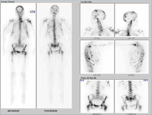 Cintigrama óseo con 99mTc-MDP muestra múltiples focos de actividad osteoblástica aumentada característicos de metástasis en mujer de 45 años con cáncer de mama.