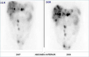 Estudio de receptores de Somatostatina con 111In-DOTATATE. Metástasis hepáticas y ganglionares en cadenas lumbo-aórtica e ilíacas de tumor carcinoide en hombre de 52 años. Control año 2007 y 2009.