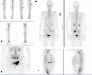 Fracturas con radiología normal. A Fracturas de stress en peroné derecho (flecha roja) y ambas tibias (flecha azul a izquierda) en deportista de 16 años con dolor. B Fracturas costales, sacroilíaca izquierda, sacro y rama isquiopubiana derecha en mujer de 71 años. C Fractura sacroilíacas y sacro en mujer de 82 años con osteoporosis severa. D Fracturas por tos en mujer de 60 años con dolor torácico.
