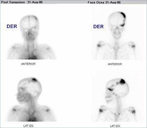 Cintigrama óseo trifásico de una niña de 10 años enviada por deformación cráneo-facial. Se muestra imágenes precoces en fase vascular (pool sanguíneo) y tardías en fase ósea. Existe moderado aumento de vascularización e intenso aumento de actividad osteoblástica en hemicráneo izquierdo con extensión a la región supraciliar concordante con displasia fibrosa ósea.