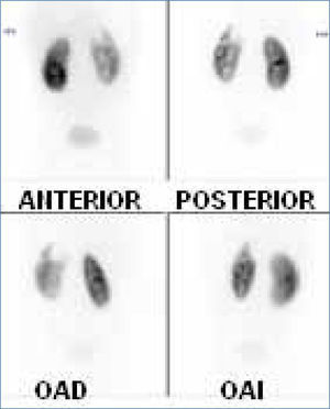 Cintigrama renal DMSA en lactante de 1 año febril muestra un extenso defecto en polo superior de riñón izquierdo y menor incorporación en general respecto al riñón derecho normal. Examen confirma Pielonefritis Aguda izquierda.