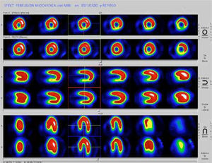 Estudio de perfusión miocárdica en esfuerzo y reposo con 99mTc-MIBI demuestra isquemia en pared inferior en esfuerzo en los cortes en el eje corto (HSA), vertical largo (VLA) y horizontal largo (HLA) del corazon.