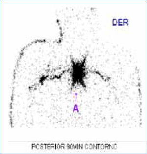Linfocintigrafía preoperatoria de melanoma maligno del dorso y extirpación de ganglio centinela muestra trayectos linfáticos hacia ambas axilas en un hombre de 38 años. A = sitio de inyección
