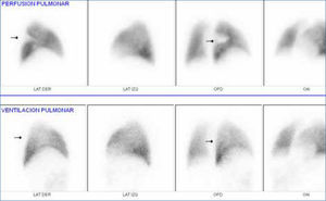 Cintigrama pulmonar de perfusión y ventilación en hombre de 57 años muestra un defecto de perfusión neto en segmento superior del lóbulo inferior con ventilación conservada (señalado con flechas). Imágenes superiores corresponden a la perfusión e inferiores a la ventilación.