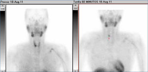 Imágenes precoz y tardía con 99mTc-MIBI demuestra retención aumentada confirmando un adenoma paratiroideo inferior derecho.