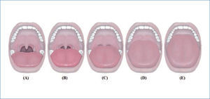 Clasificación de friedman Valora las estructuras anatómicas faríngeas con el paciente en posición sentada y la boca completamente abierta, la lengua dentro de la cavidad oral y sin depresor. A: normal y E: máximo grado de obstrucción y en consecuencia de predicción de SAHOS (A) Se visualiza úvula completa, amígdalas y pilares. (B) Se visualiza gran parte de la úvula, pero no las amígdalas y los pilares. (C) Se visualiza el paladar blando y base de la úvula. (D) se visualiza parte del paladar blando, pero no las estructuras más distales. (E) se visualiza solo el paladar duro.