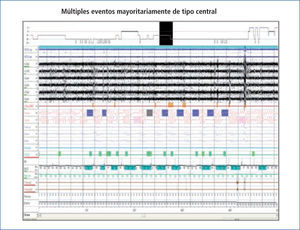 Estudio basal Titulación automática con Adaptative Servo Ventilador (ASV). Paciente con fallo cardíaco estable (Fracción de eyección 35%) y síndrome de Apnea-Hipopnea Central del Sueño (SAHCS) con múltiples eventos respiratorios de origen, mayoritariamente, central (Figura 3A).