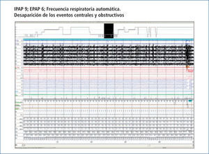 Titulación automática con ASV Titulación automática con ASV (EPAP fija a 6 cm; IPAP a 9 cm con frecuencia respiratoria automática). Desaparición de los eventos respiratorios (Figura 3B).
