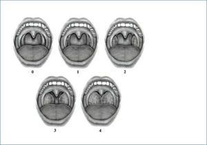 escala de brodsky para evaluación de tamaño amigdalino Las amígdalas son clasificadas como grado 0 (amígdalas dentro de la fosa amigdalina), grado 1 (amígdalas se asoman de fosa amigdalina y ocupan menos del 25% del ancho de la orofaringe), grado 2 (amígdalas ocupan entre el 26%-50% del ancho orofarín-geo), grado 3 (amígdalas ocupan entre el 51%-75% del ancho orofaríngeo) o grado 4 (amígdalas ocupan más del 75% del ancho orofaríngeo).