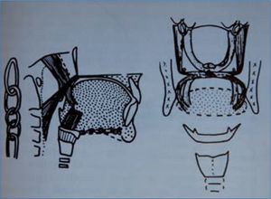 Esquema con la participación de los anillos musculares velopalatinos y orofaringeos en la suspensión o tracción superior de la base lingual y en la mantención del diámetro de la vía aérea (8, 9).