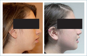 Paciente con retrognatismo en sus fotografias de perfil pre operatorias y post cirugía ortognática de avance bi maxilar.