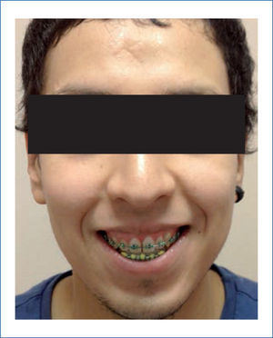 Fotografía frontal de paciente con retrognatismo y su marcado crecimiento vertical del maxilar superior.