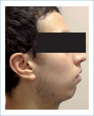 Fotografía de perfil de paciente con retrognatismo y su evidente falta de desarrollo y proyección mandibular.
