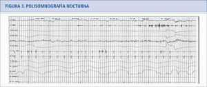 Trastorno de conducta durante el sueño REM (RBD, REM Behavior Disorder). En el segundo canal, se produce una ausencia de atonía en musculatura mento-niana durante la fase REM del sueño.