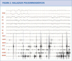 Paciente con TCSR donde podemos ver actividad fásica excesiva en las extremidades superiores e inferiores preservándose la atonía en el músculo mentalis. EOG: electrooculograma. F3: actividad EEG frontal izquierda, F4: actividad EEG frontal derecha. C3: actividad EEG central izquierda. C4: actividad EEG central derecha. O1: actividad EEG occipital izquierda. 02: actividad EEG occipital derecha. MEN: músculo mentalis. LFDS: flexor de los dedos superficial izquierdo. RFDS: flexor de los dedos superficial derecho. LTA: tibial anterior izquierdo. RTA: tibial anterior derecho. LEDB: extensor breve de los dedos izquierdo. REDB: extensor breve de los dedos derecho.