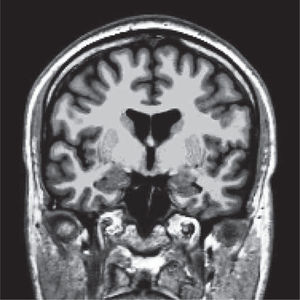 Imagen volumétrica ponderada en T1 de un sujeto normal. Resolución espacial de 1 mm en los tres planos espaciales. Reconstrucción coronal.